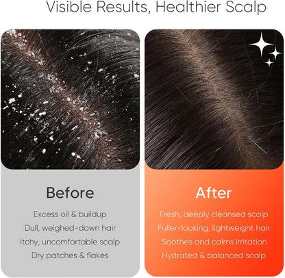 Sonic Vibrating Scalp Massager Shampoo Brush – Electric Silicone Hair Scrubber for Deep Scalp Cleansing, Dandruff Removal, Rich Foam & Relaxing Massage, Wet & Dry Use, USB-C Charging